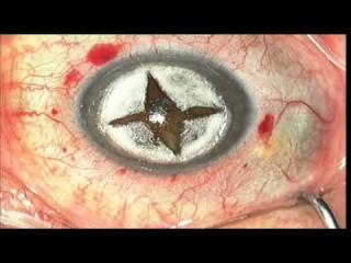 Keratoplasty: Overview