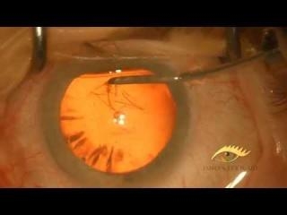 Cataract: Capsulorhexis
